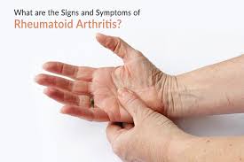 manage sign of rheumatoid arthritis