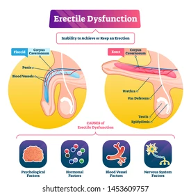 Premature ejaculation (PE) affects millions of men, causing stress, low self-esteem, and relationship issues. Thankfully, Duratia 60 mg is an effective treatment that helps restore confidence and intimacy.